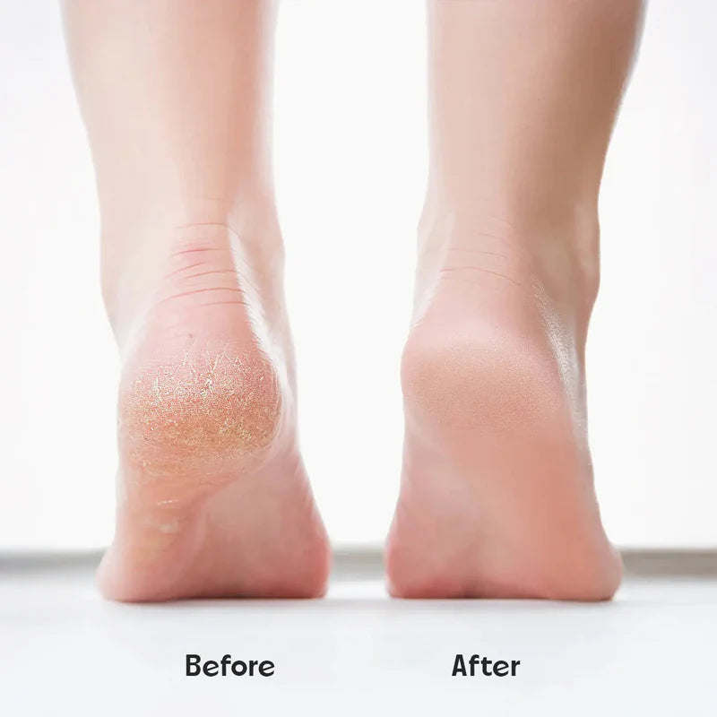 SilkySole™ Rechargeable Foot File for Dead Skin & Callus Removal