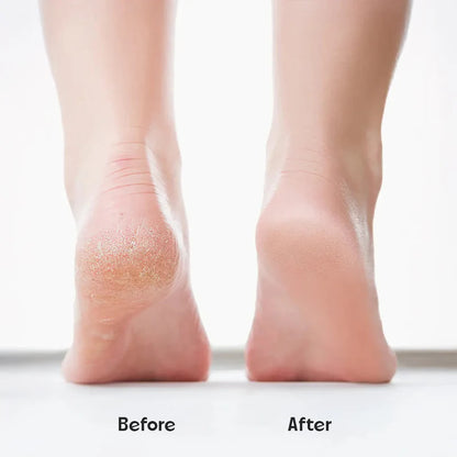 SilkySole™ Rechargeable Foot File for Dead Skin & Callus Removal